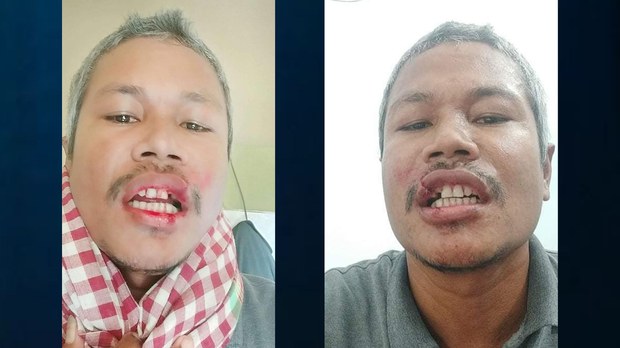 ចៅ​សង្កាត់​រង​ទី២ ជាប់​ឆ្នោត​គណបក្ស​សង្គ្រោះ​ជាតិ ត្រូវ​ជន​មិន​ស្គាល់​មុខ​លួច​វាយ​ប្រហារ​នឹង​ដុំ​ថ្